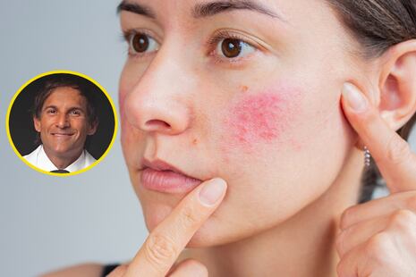 ¿Qué es la rosácea y cómo controlarla? Un experto lo explica