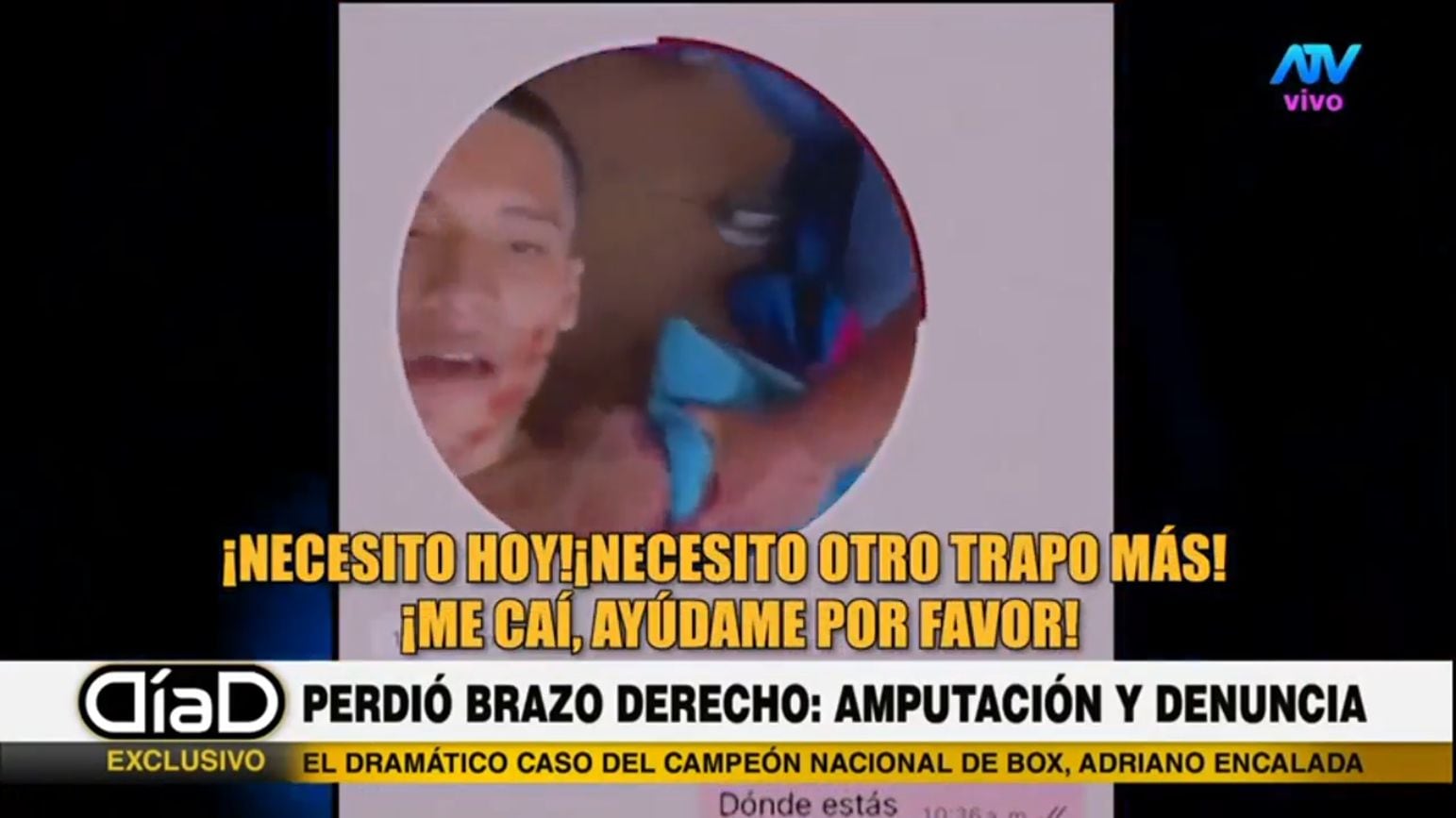 Boxeador peruano perdió brazo por negligencia médica. Foto: Día D