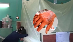 ¡Alerta en Piura! Detectan primer caso de lepra en años y activan protocolos de emergencia