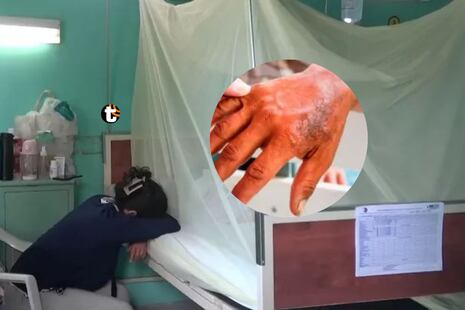 ¡Alerta en Piura! Detectan primer caso de lepra en años y activan protocolos de emergencia