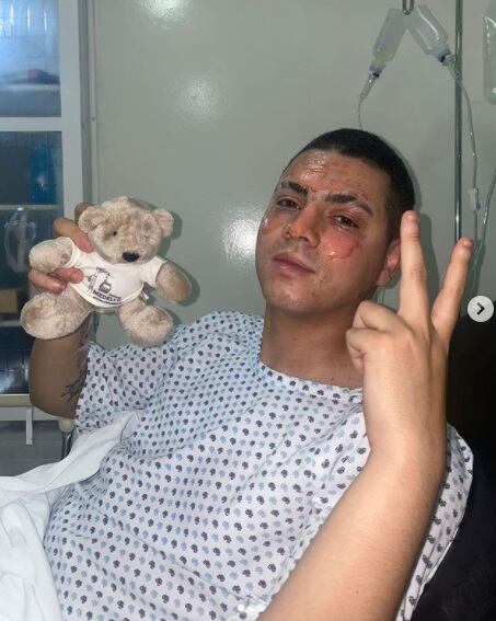 Omar Yubeili, reconocido por su participación en “Mañana es para siempre”, sufrió quemaduras en su rostro a causa de una explosión por gas (Foto: Omar Yubeili/ Instagram)