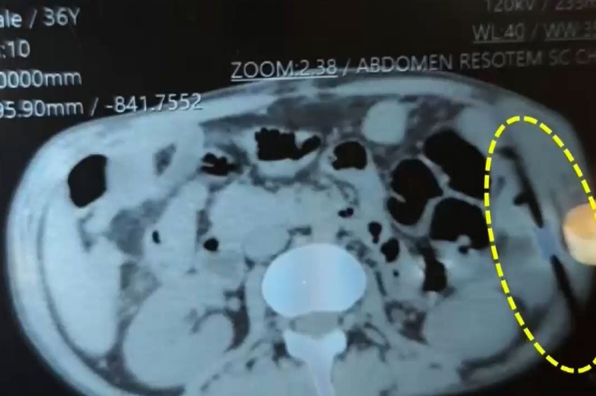 Las placas de Rony Suárez muestran una grapa mal cerrada. Foto: América Noticias