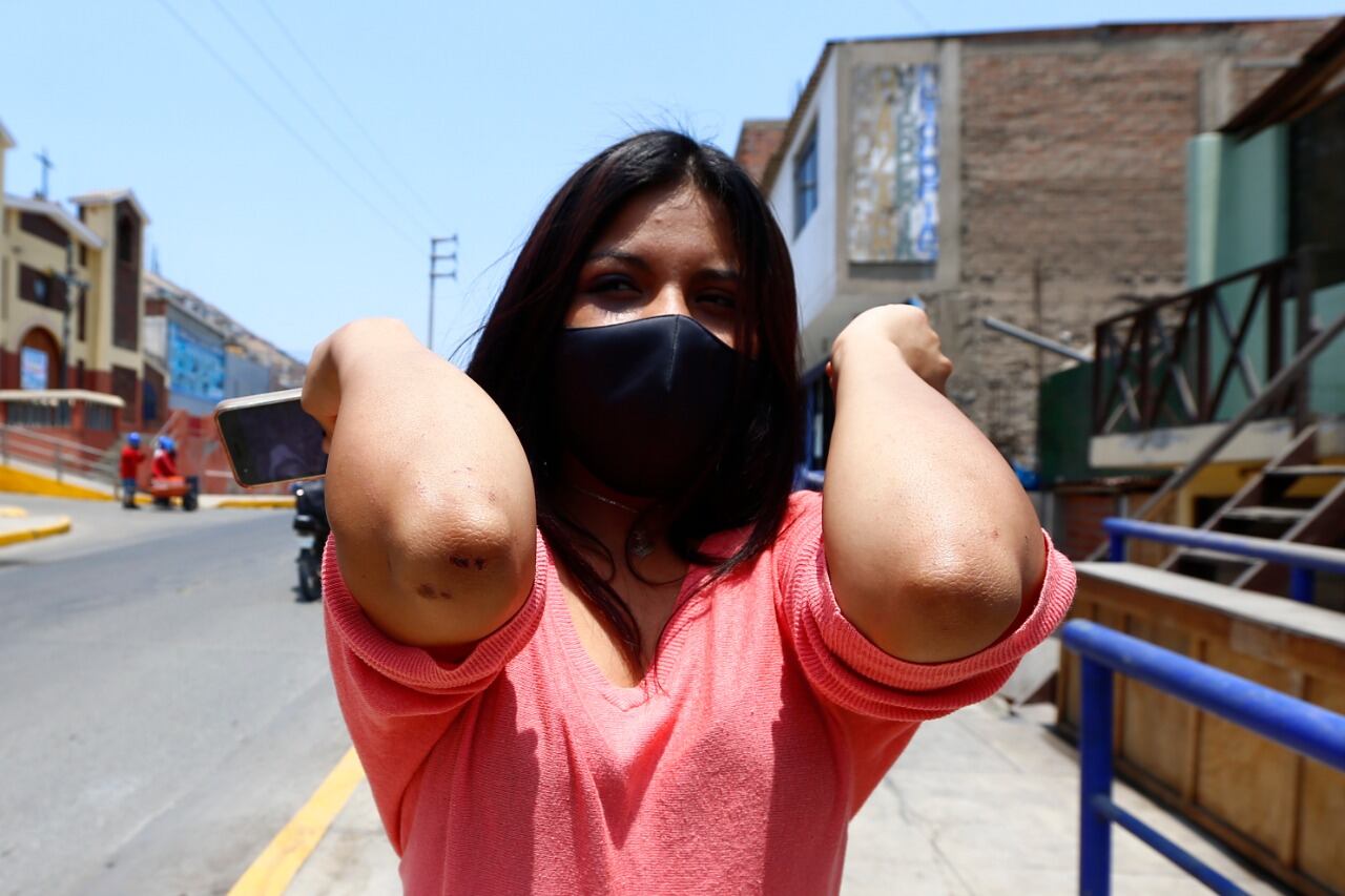 Producto del robo, madre de familia sufrió raspones en los codos y piernas, además de haber terminado con el ojo morado. | Foto: Violeta Ayasta