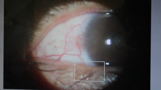 Diagnóstico neoplasia intraepitelial córneo-conjuntival del ojo derecho de grado moderado (Foto: Minsa)