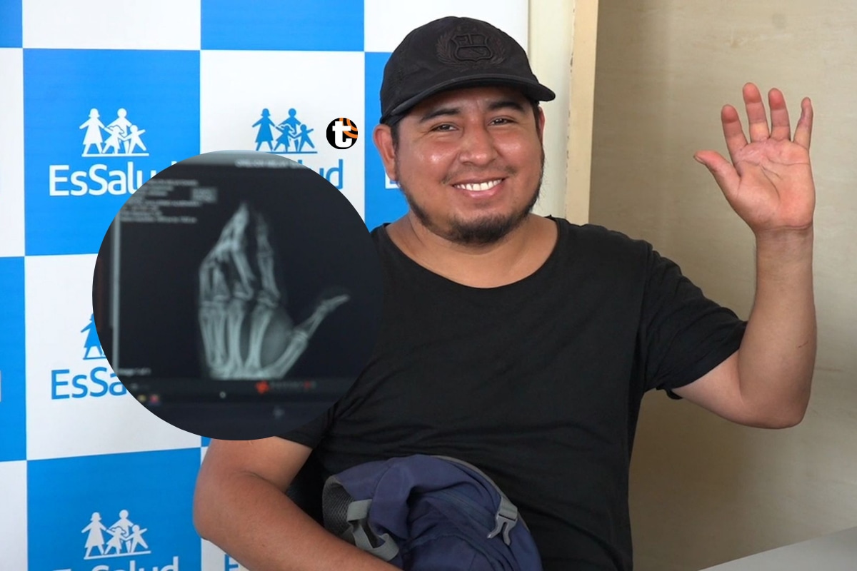 EsSalud Almenara reconstruye mano a mecánico con exitoso reimplante de dedos.