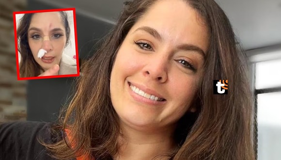 Yidda Slava se rompe la nariz