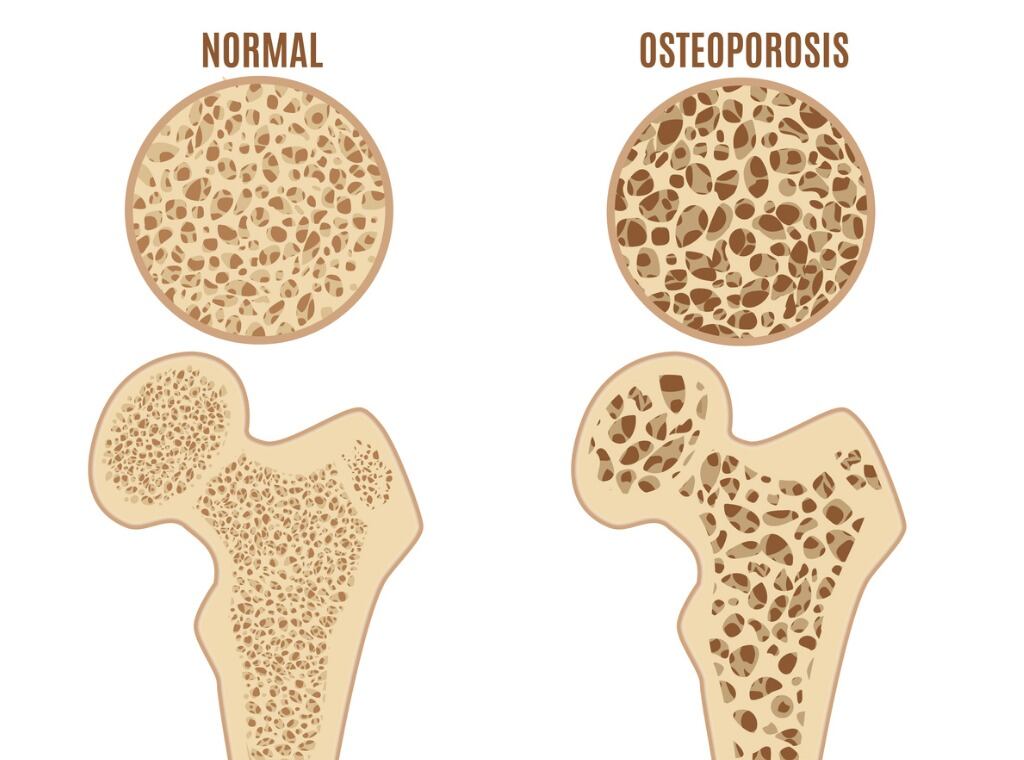 Osteoporosis. Foto: ¡Stock.