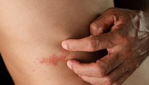Herpes Zóster: Conoce los mitos y verdades de esta enfermedad