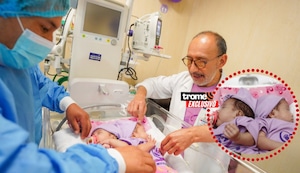 Nacen gemelitas siamesas prematuras: Con atención especializada y mucho amor las preparan para cirugía