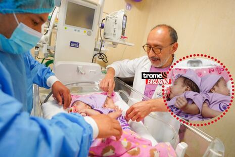 Nacen gemelitas siamesas prematuras: Con atención especializada y mucho amor las preparan para cirugía