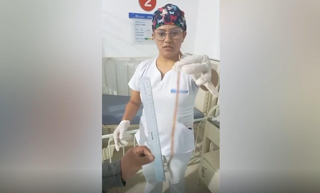 Bebé de dos años expulsó lombriz intestinal de más de 40 centímetros.