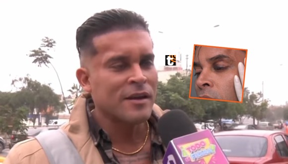 TROME - Domínguez vuelve a la TV con el ojo morado y responde si Karla Tarazona tiene la culpa: ¿Qué dijo?