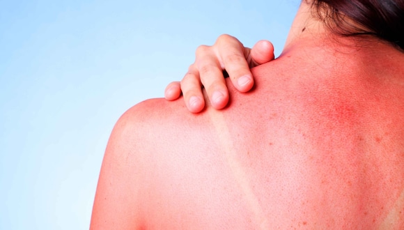 La exposición prolongada al sol también causa envejecimiento prematuro, que se manifiesta en arrugas, líneas finas, manchas marrones, pérdida de elasticidad y piel áspera.