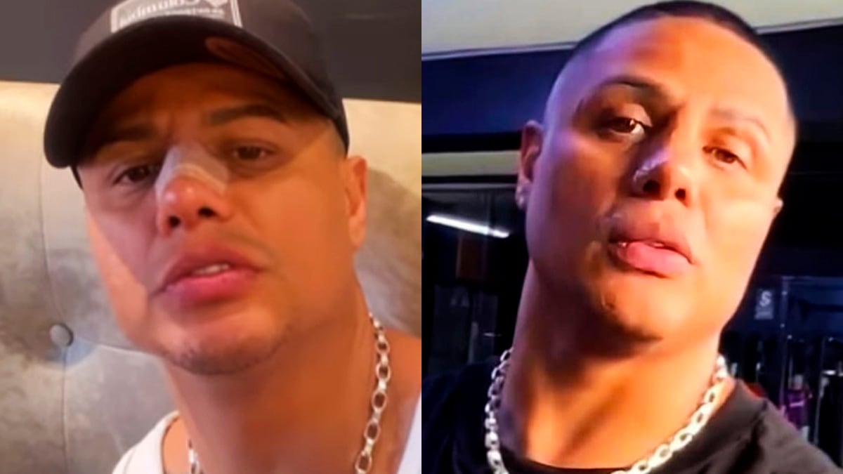 Así quedó Jonathan Maicelo luego de sorprendente cambio tras operarse la nariz |