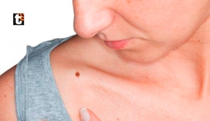 Cuidado con el cáncer de piel