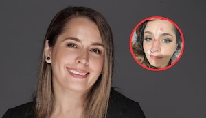 Yiddá Eslava sobre su lesión: “Voy a quedar con la nariz de Michael Jackson”