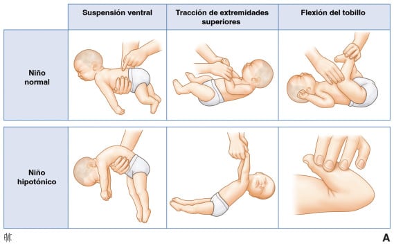Cómo reconocer hipotonía en un bebé. Foto: Internet.