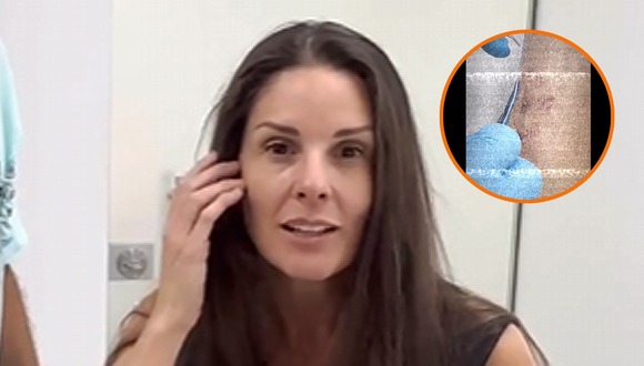 TROME - Rebeca Escribens revela que le detectaron cáncer de piel: “Quedé en shock, lloré y peleé. Nunca más sol”