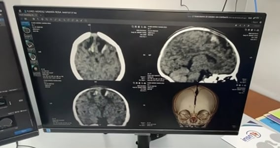 Hemorragia intracraneal de bebé de un mes masacrada por sus padres