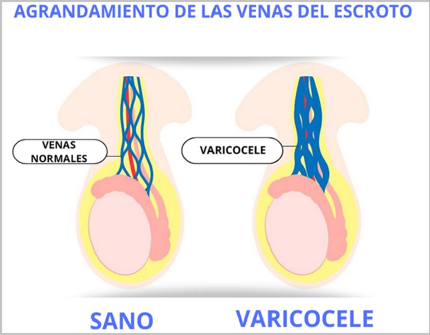 Es la presencia de dilataciones varicosas en las venas del cordón espermático dentro del escroto.
