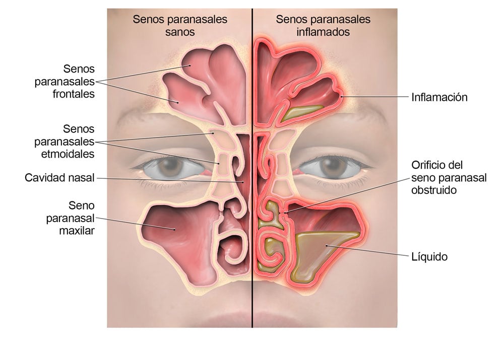 Conoce los síntomas, las señales de alerta, el tratamiento y las posibles complicaciones de la sinusitis infantil. Foto: CDC Estados Unidos / Istock.
