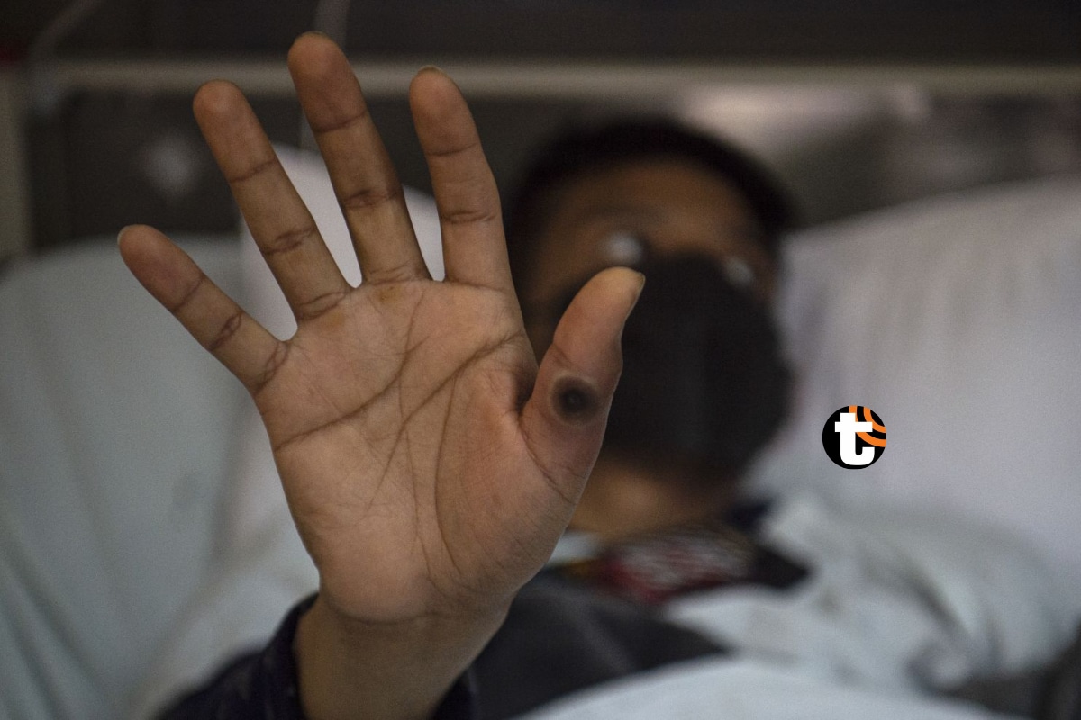 Un paciente muestra su mano con una llaga causada por una infección del virus de la viruela símica, en el área de aislamiento para pacientes con viruela del mono del hospital Arzobispo Loayza, en Lima, Perú, el 16 de agosto de 2022 (Foto: Ernesto Benavides / AFP)