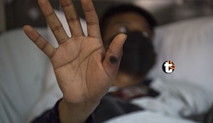 Viruela del mono: Minsa asegura que no tenemos ningún caso reportado de nueva variante