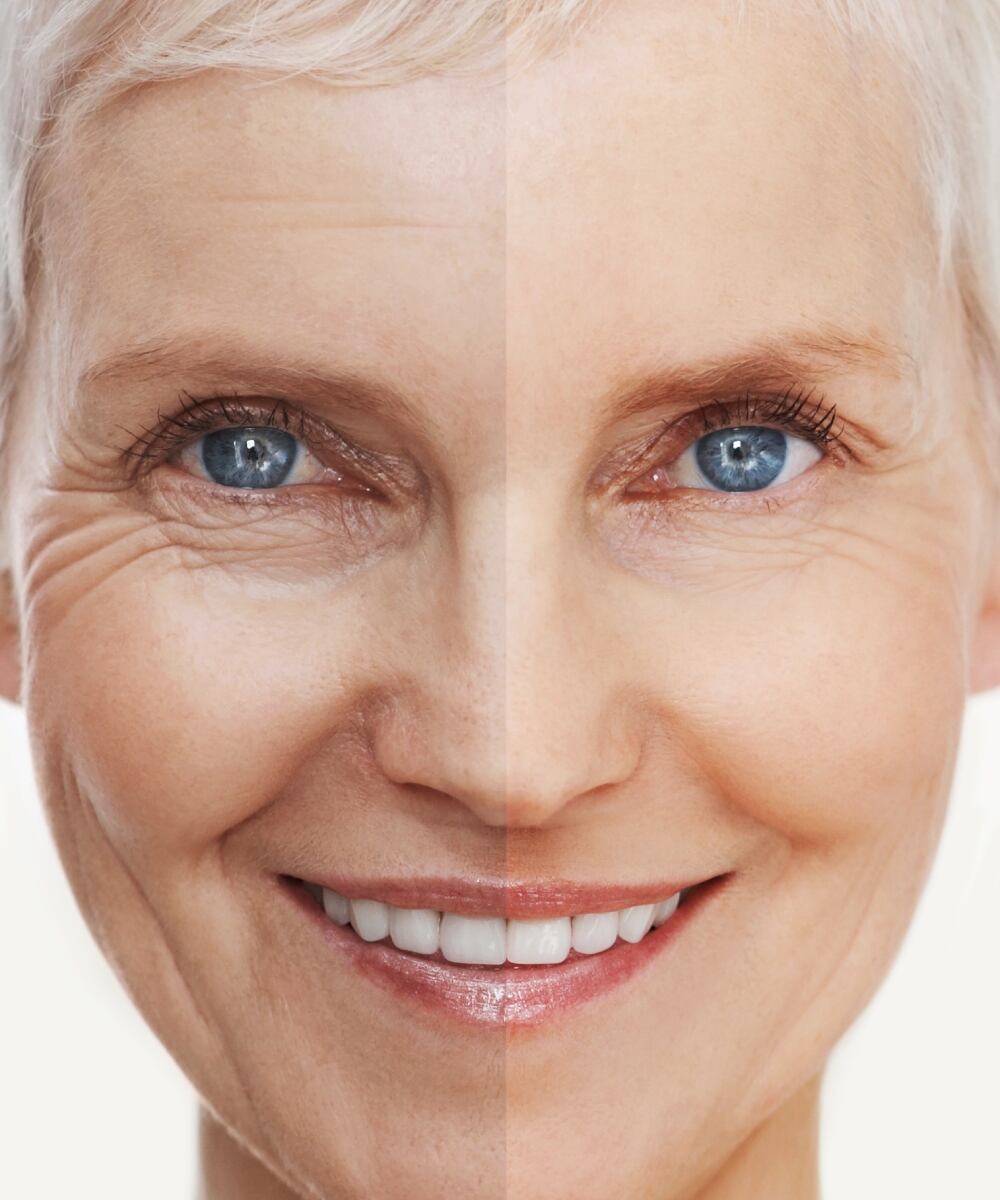 ¿Qué son los bioestimuladores faciales? Foto: Istock.