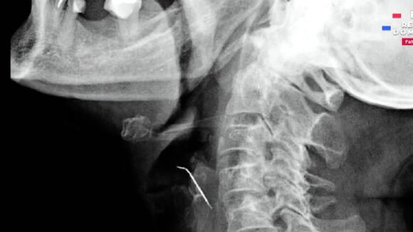 Mujer sobrevive más de 40 días con un clavo incrustado en la arteria carótida tras comer un chicharrón