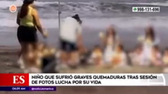 Niño que sufrió graves quemaduras tras sesión de fotos lucha por su vida