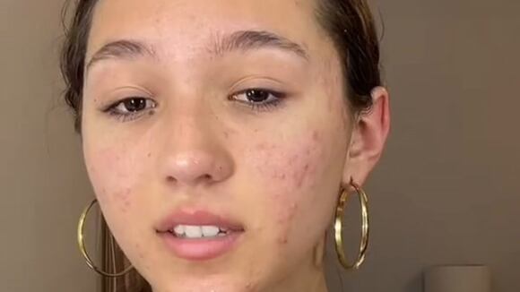 TROME | Alexia Barnechea rompe en llanto por su acné