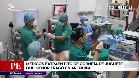 Médicos extraen pito de juguete que niño tragó en Arequipa