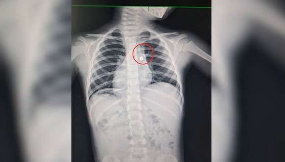 La Libertad: Médicos de EsSalud salvan a niño con pila en el pulmón. (Video EsSalud)