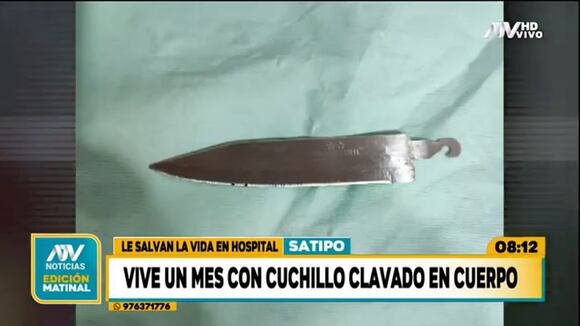 Trome | Joven vive con un cuchillo en espalda en Huánuco