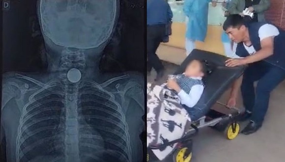 Cusco: Niña se traga moneda durante bienvenida al primer día de clases y es operada.