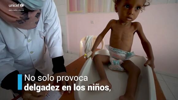 ¿Qué Es La Desnutrición Aguda Grave ¿Cómo Combatirla