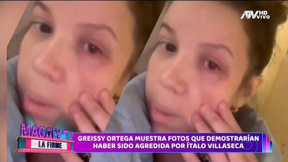 TROME - Greissy denunció a Ítalo en EE.UU.: Mostró un ojo morado y aseguró que golpiza le hizo perder a su bebé de 7 meses