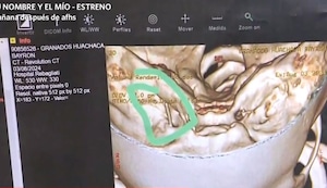 Niño termina con aguja en cabeza tras visita al dentista