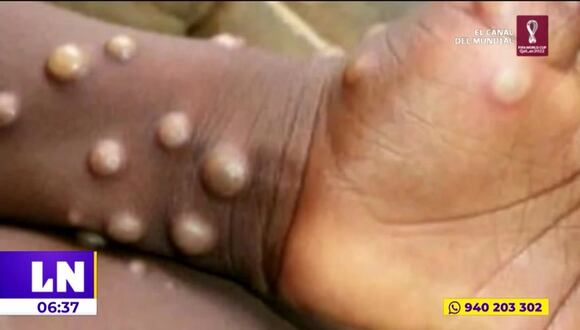 Viruela del mono: Hospitales de Ate y Villa El Salvador atenderán los posibles casos en nuestro país