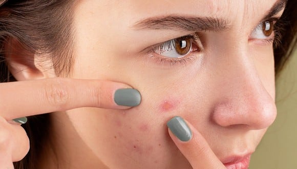Remedios caseros para atenuar el acné de forma saludable y natural. (Foto: Pexels)