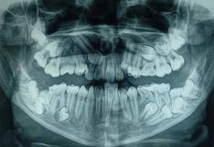 Hospital del Niño: Retiran 16 dientes que tenía de más campeona de karate