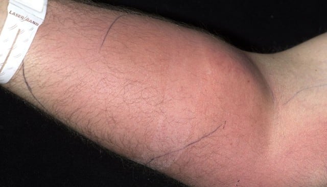 Se inyectó su semen en su brazo para calmar el dolor de espalda y casi se muere. (Fotos: Irish Medical Journal)