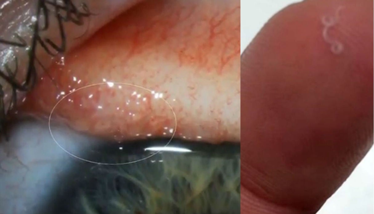 Mujer se contagió de extraña infección que hizo que los ojos se le llenaran de gusanos
